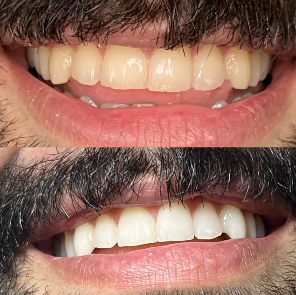 Clareamento Dental